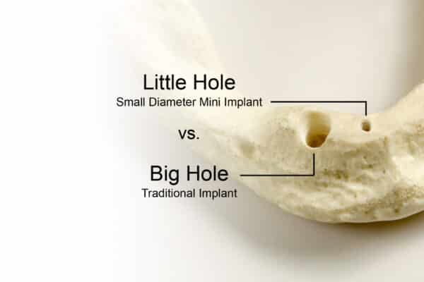 Chicago Implant Dentist Explains The Benefits of Mini Dental Implants