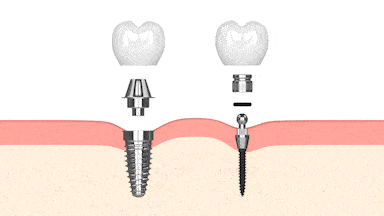 Traditional Dental Implants vs. Mini Dental Implants