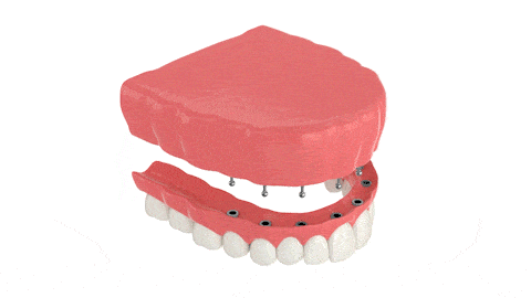 Dentures Hope Dental Mini Dental Implants in Chicago, IL