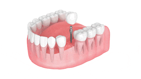 Mini Dental Implants in Countryside, IL