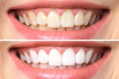 Teeth Whitening in Countryside, IL