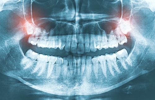 Tooth Extractions in Countryside, IL - Wisdom Tooth Extraction